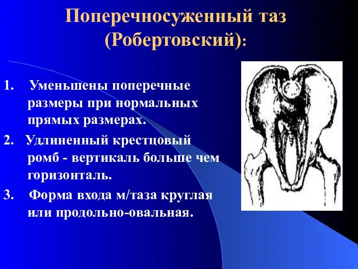 Поперечносуженный таз (Робертовский): 1. Уменьшены поперечные размеры при нормальных прямых