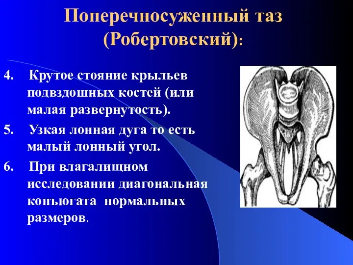 Поперечносуженный таз (Робертовский): 4. Крутое стояние крыльев подвздошных костей (или