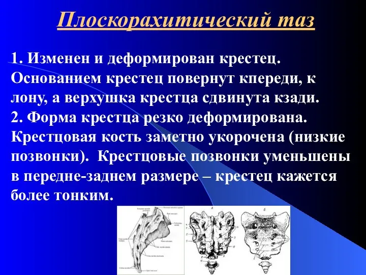 Плоскорахитический таз 1. Изменен и деформирован крестец. Основанием крестец повернут