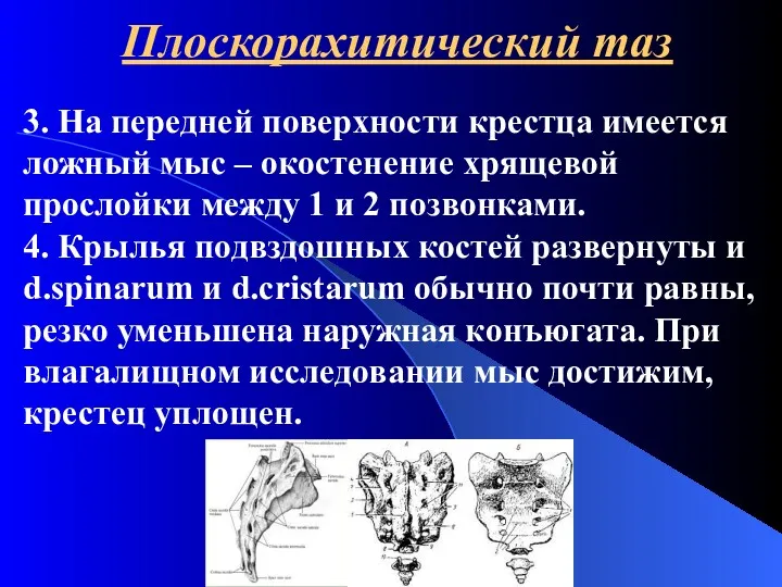 Плоскорахитический таз 3. На передней поверхности крестца имеется ложный мыс