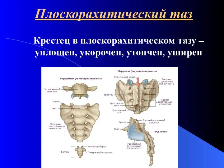 Плоскорахитический таз Крестец в плоскорахитическом тазу – уплощен, укорочен, утончен, уширен