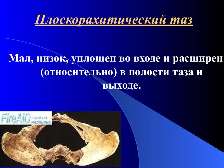 Плоскорахитический таз Мал, низок, уплощен во входе и расширен (относительно) в полости таза и выходе.