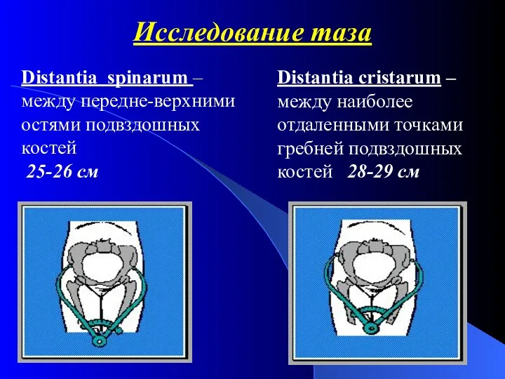 Исследование таза Distantia spinarum – между передне-верхними остями подвздошных костей