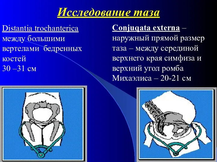 Исследование таза Distantia trochanterica между большими вертелами бедренных костей 30