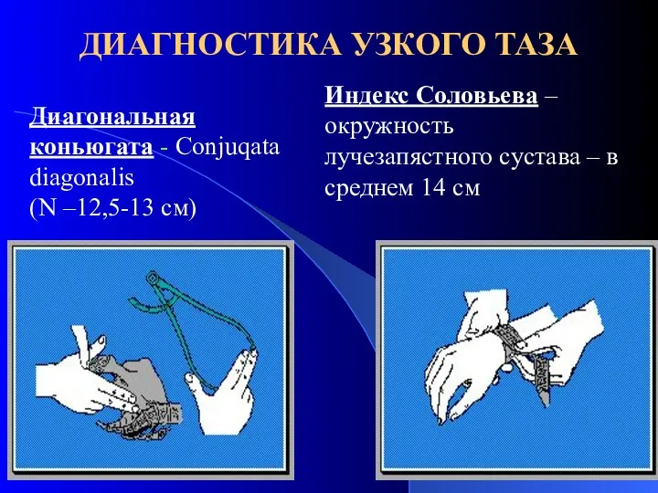 ДИАГНОСТИКА УЗКОГО ТАЗА Диагональная коньюгата - Cоnjuqata diagonalis (N –12,5-13