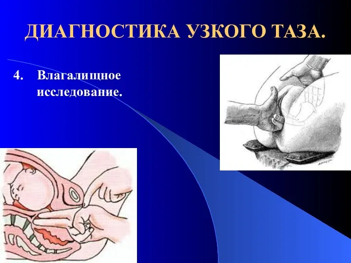 ДИАГНОСТИКА УЗКОГО ТАЗА. 4. Влагалищное исследование.