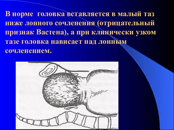 В норме головка вставляется в малый таз ниже лонного сочленения