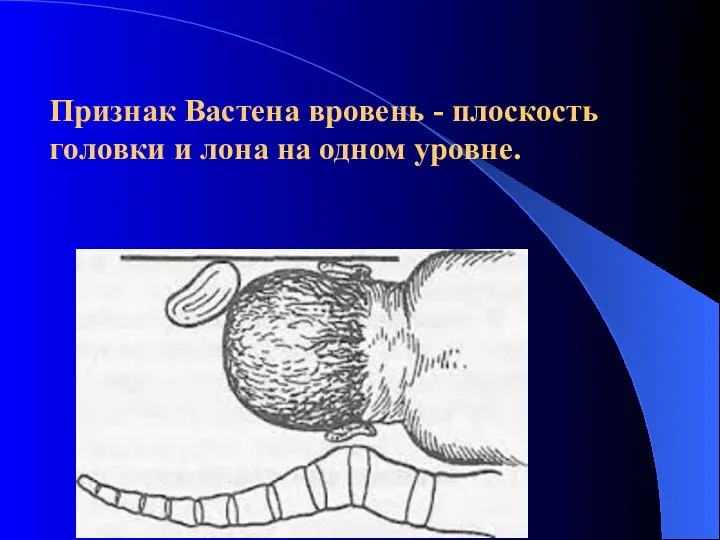 Признак Вастена вровень - плоскость головки и лона на одном уровне.