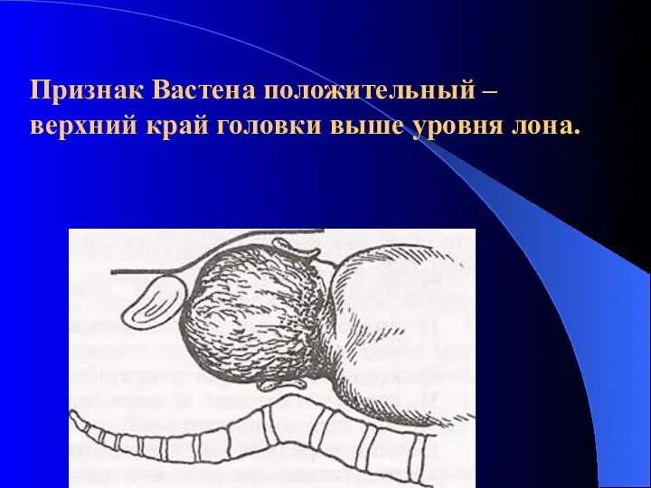 Признак Вастена положительный – верхний край головки выше уровня лона.