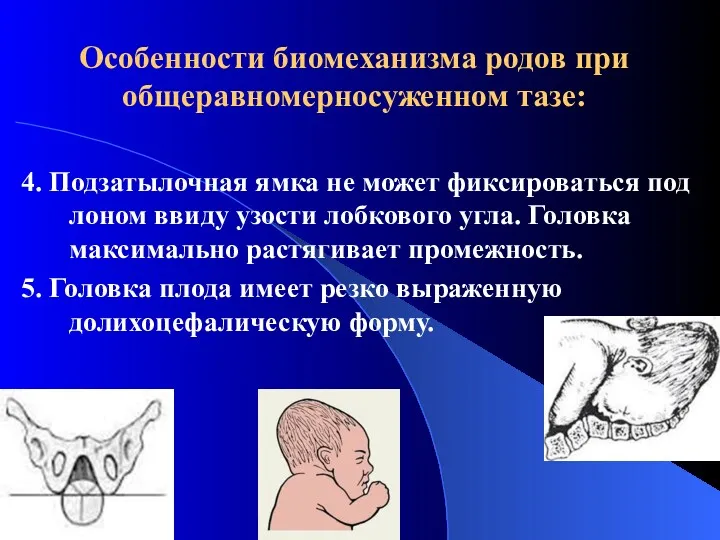 Особенности биомеханизма родов при общеравномерносуженном тазе: 4. Подзатылочная ямка не