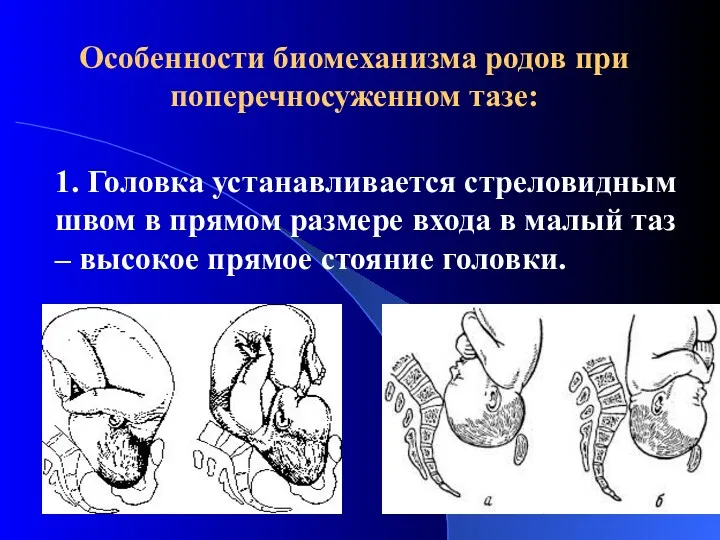 Особенности биомеханизма родов при поперечносуженном тазе: 1. Головка устанавливается стреловидным