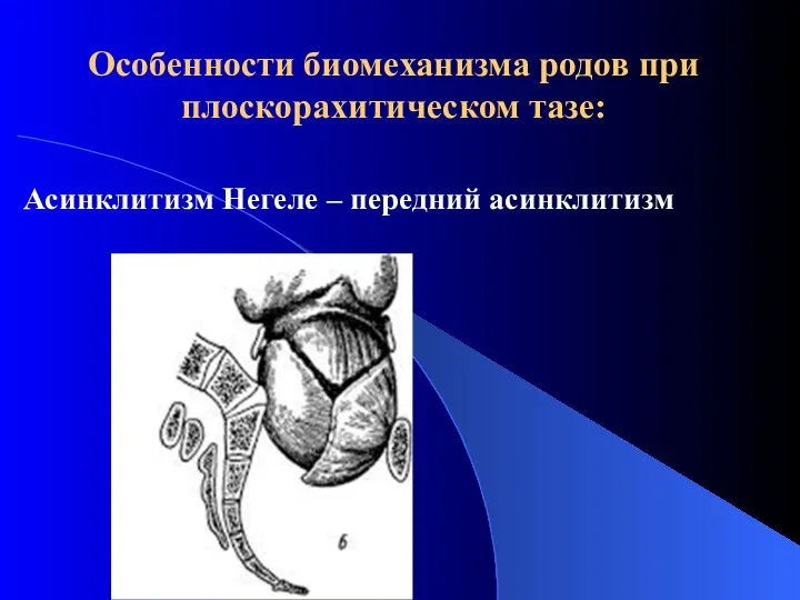 Особенности биомеханизма родов при плоскорахитическом тазе: Асинклитизм Негеле – передний асинклитизм