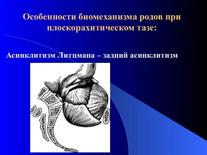 Особенности биомеханизма родов при плоскорахитическом тазе: Асинклитизм Литцмана – задний асинклитизм