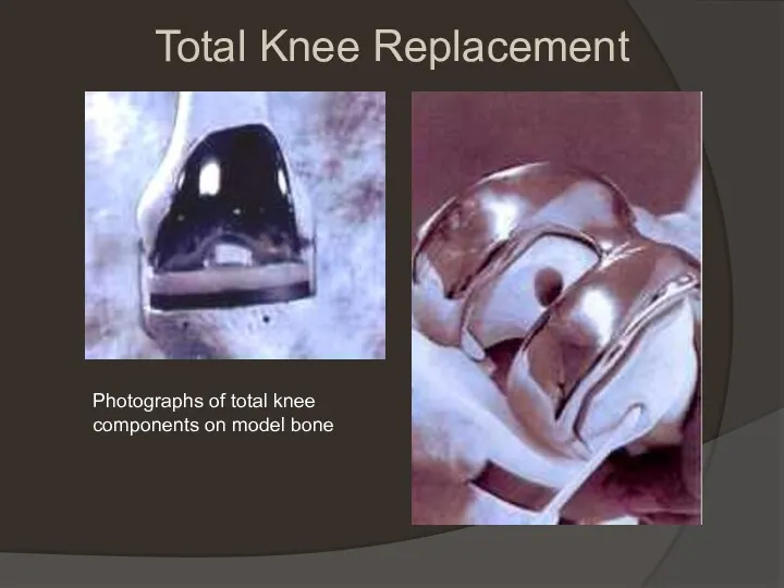 Total Knee Replacement Photographs of total knee components on model bone