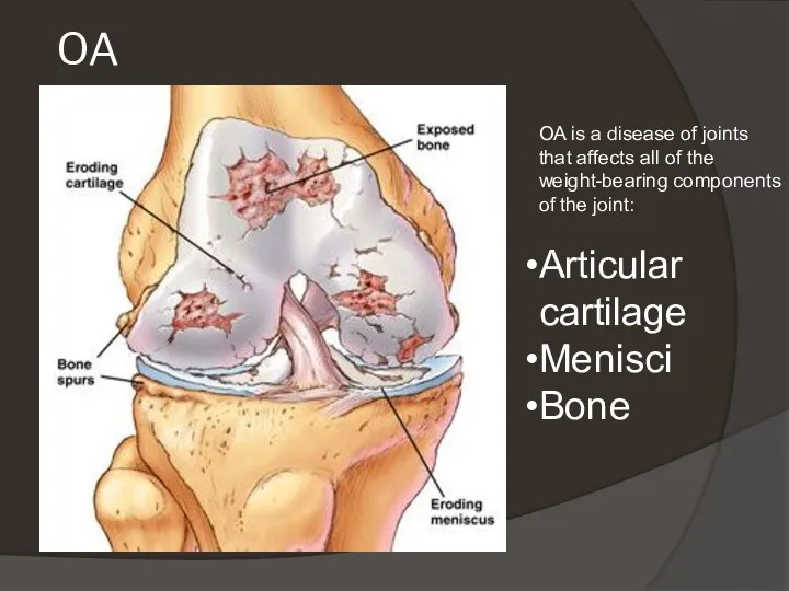 OA OA is a disease of joints that affects all