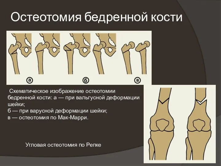 Остеотомия бедренной кости Схематическое изображение остеотомии бедренной кости: а —