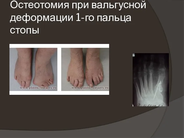 Остеотомия при вальгусной деформации 1-го пальца стопы