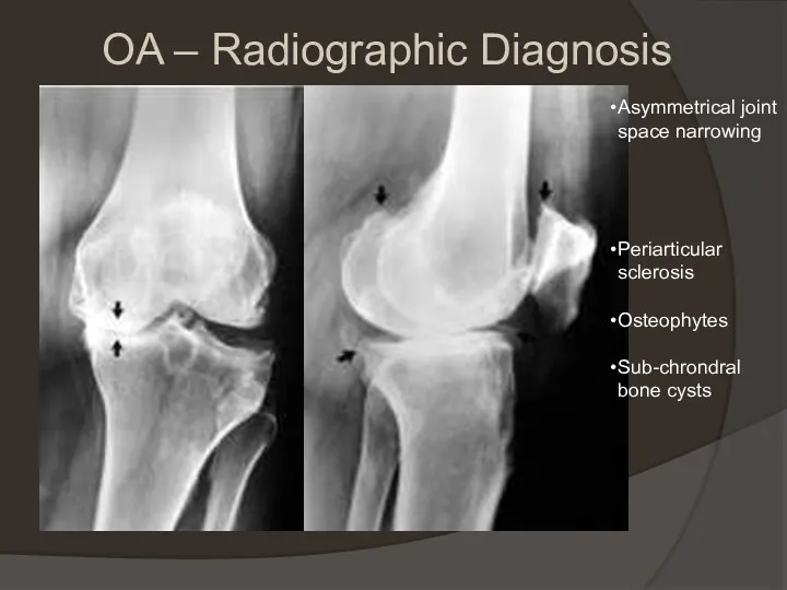 OA – Radiographic Diagnosis Asymmetrical joint space narrowing Periarticular sclerosis Osteophytes Sub-chrondral bone cysts