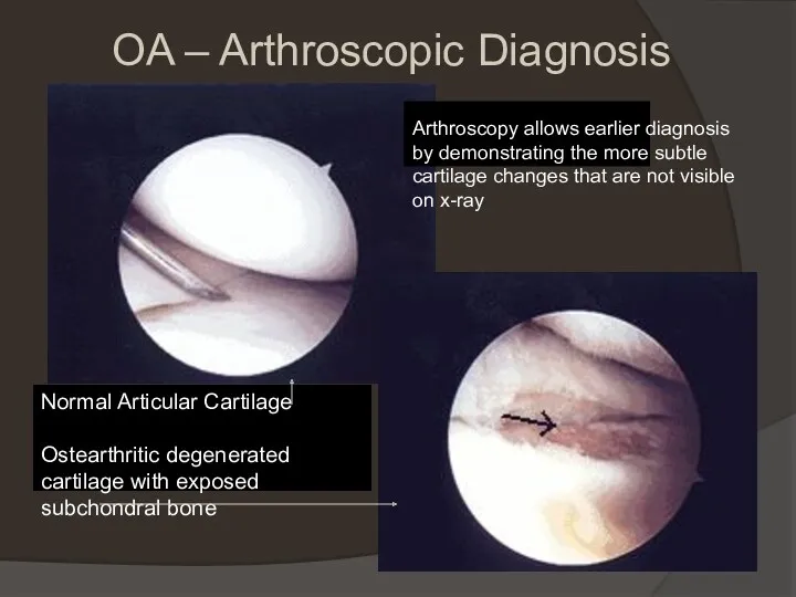 OA – Arthroscopic Diagnosis Arthroscopy allows earlier diagnosis by demonstrating the more subtle