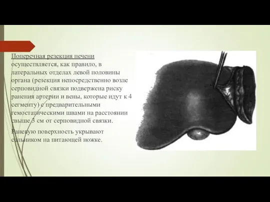 Поперечная резекция печени осуществляется, как правило, в латеральных отде­лах левой