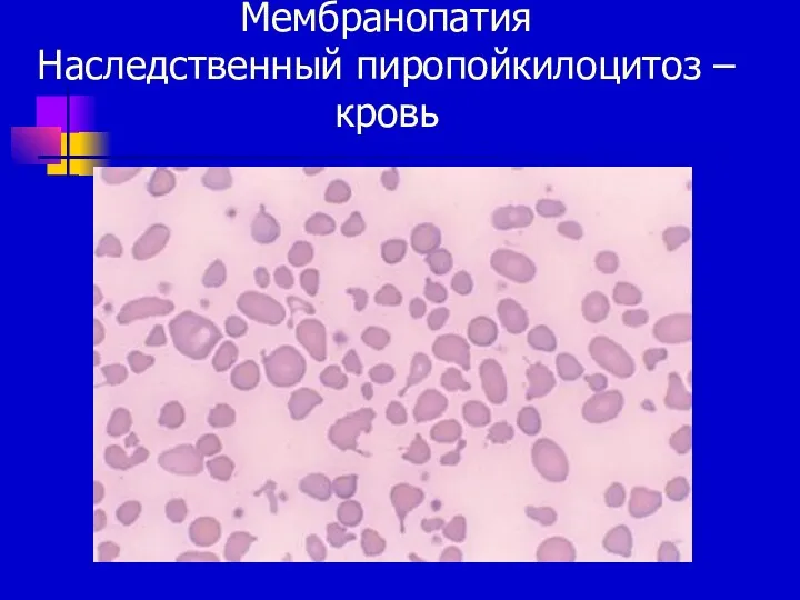 Мембранопатия Наследственный пиропойкилоцитоз – кровь