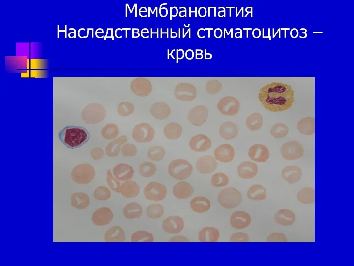 Мембранопатия Наследственный стоматоцитоз – кровь