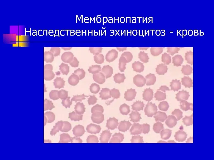 Мембранопатия Наследственный эхиноцитоз - кровь