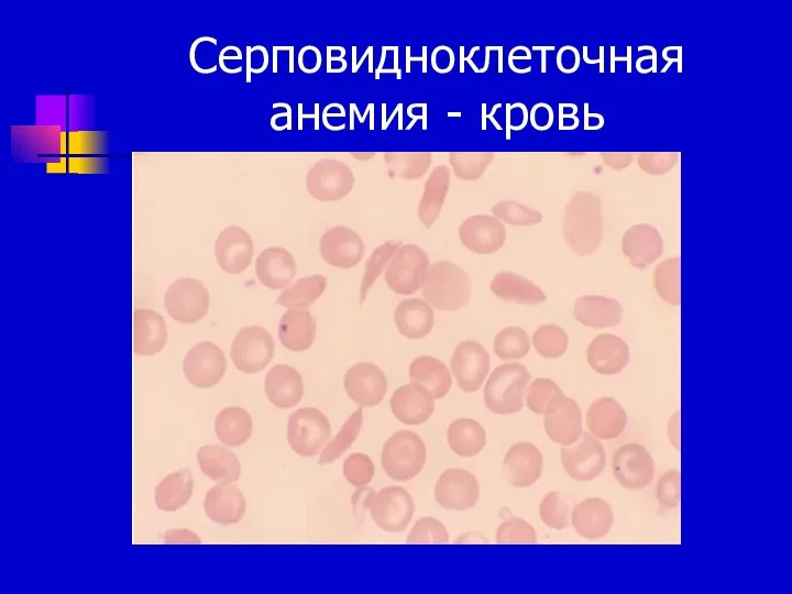 Серповидноклеточная анемия - кровь