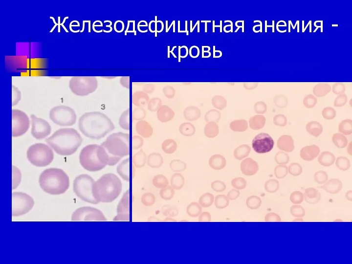 Железодефицитная анемия - кровь