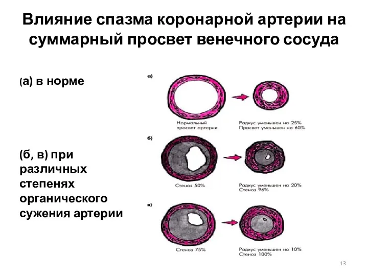 Влияние спазма коронарной артерии на суммарный просвет венечного сосуда (а) в норме (б,