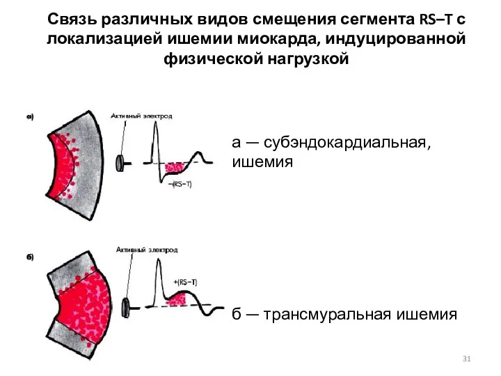 Связь различных видов смещения сегмента RS–T с локализацией ишемии миокарда, индуцированной физической нагрузкой