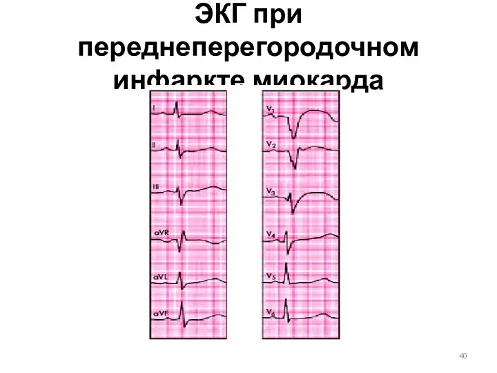 ЭКГ при переднеперегородочном инфаркте миокарда