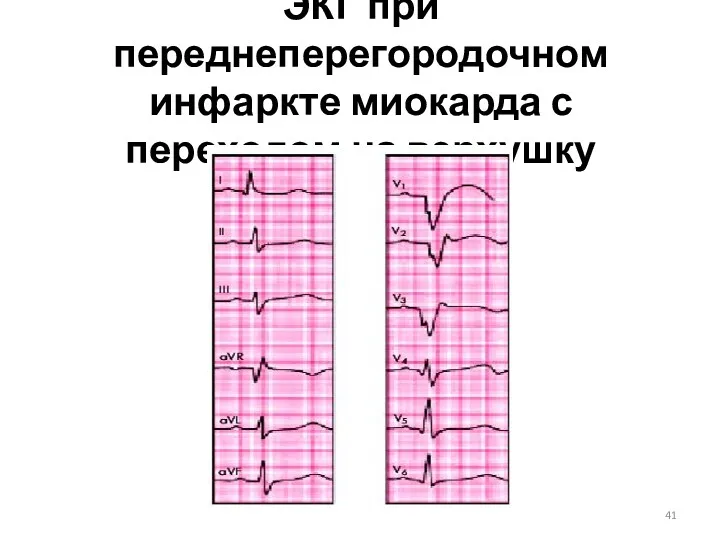 ЭКГ при переднеперегородочном инфаркте миокарда с переходом на верхушку