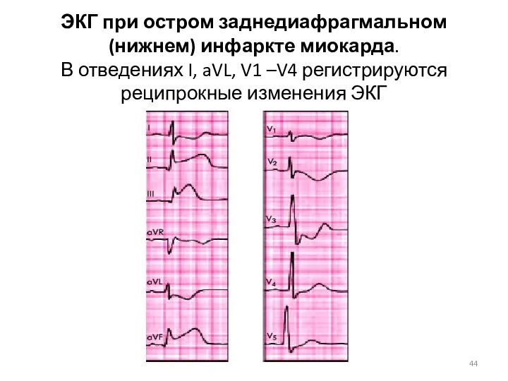 ЭКГ при остром заднедиафрагмальном (нижнем) инфаркте миокарда. В отведениях I, aVL, V1 –V4