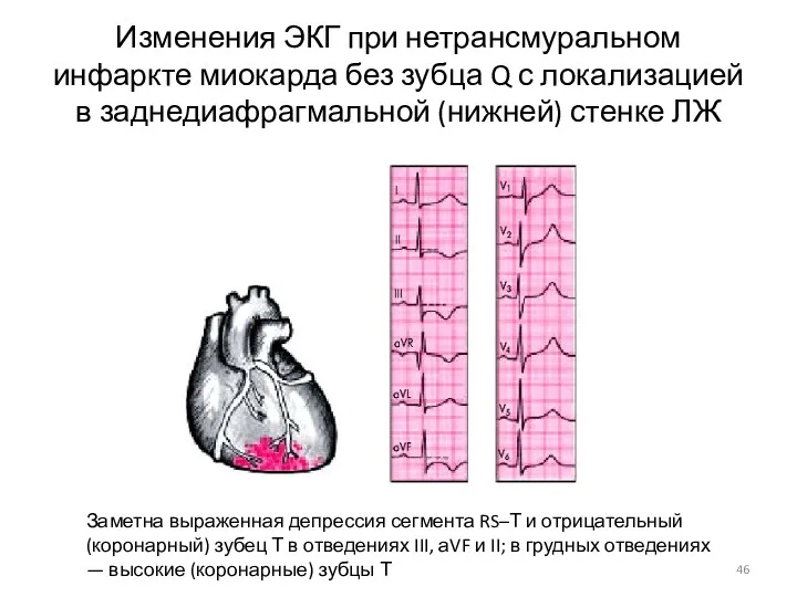 Изменения ЭКГ при нетрансмуральном инфаркте миокарда без зубца Q с локализацией в заднедиафрагмальной
