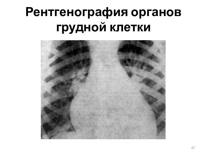 Рентгенография органов грудной клетки