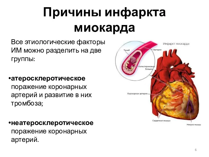 Причины инфаркта миокарда Все этиологические факторы ИМ можно разделить на две группы: атеросклеротическое