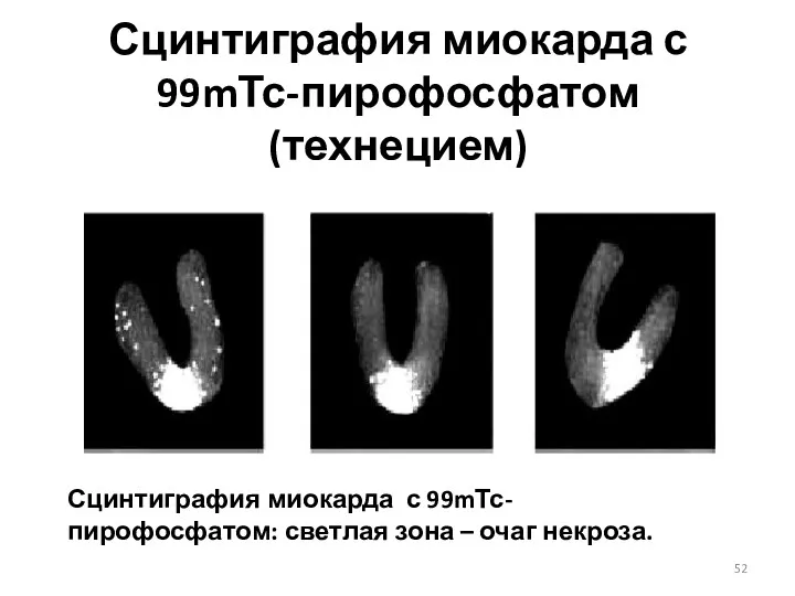 Сцинтиграфия миокарда с 99mТс-пирофосфатом (технецием) Сцинтиграфия миокарда с 99mТс-пирофосфатом: светлая зона – очаг некроза.