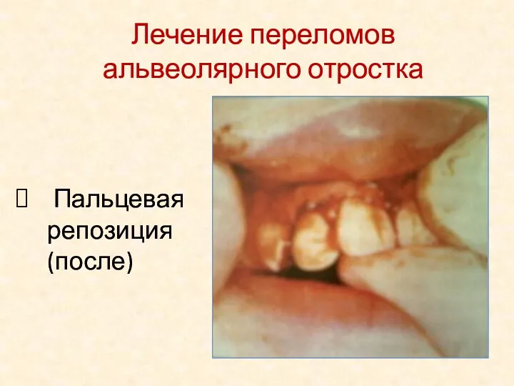 Пальцевая репозиция (после) Лечение переломов альвеолярного отростка