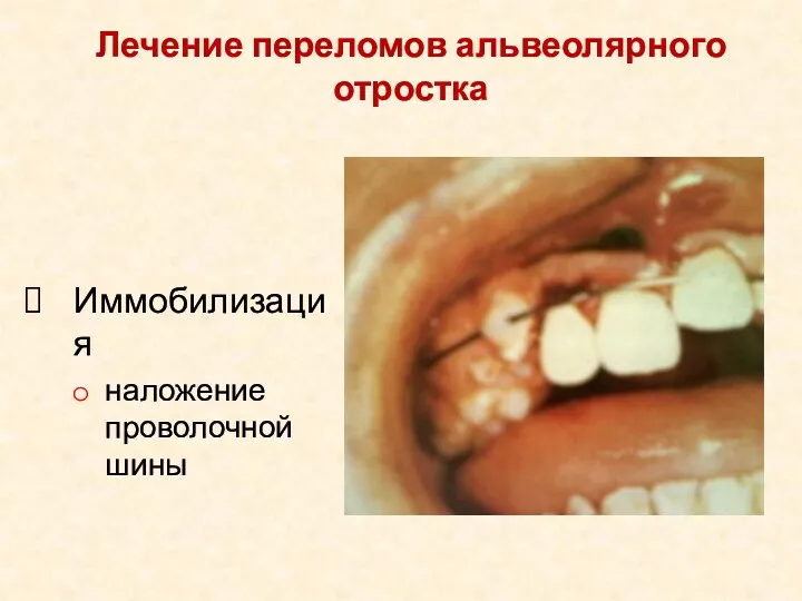 Иммобилизация наложение проволочной шины Лечение переломов альвеолярного отростка