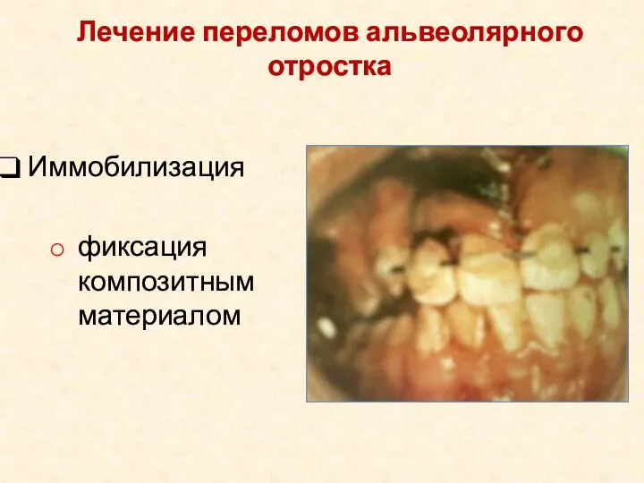 Иммобилизация фиксация композитным материалом Лечение переломов альвеолярного отростка
