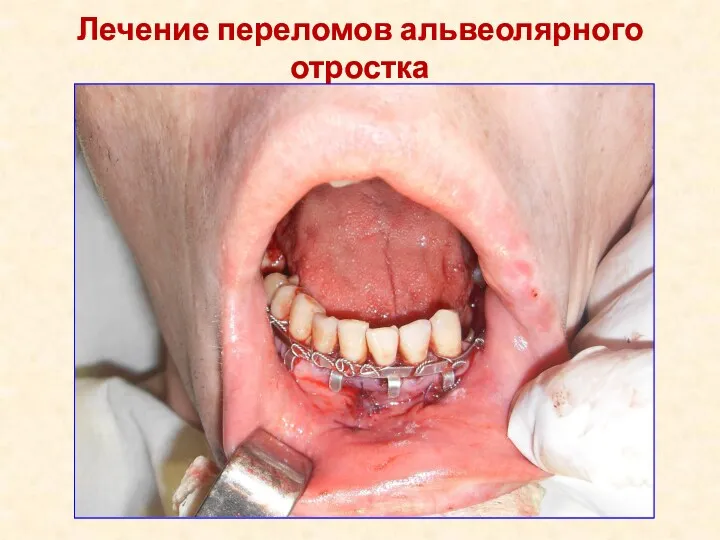 Лечение переломов альвеолярного отростка