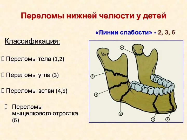 Классификация: Переломы тела (1,2) Переломы угла (3) Переломы ветви (4,5)