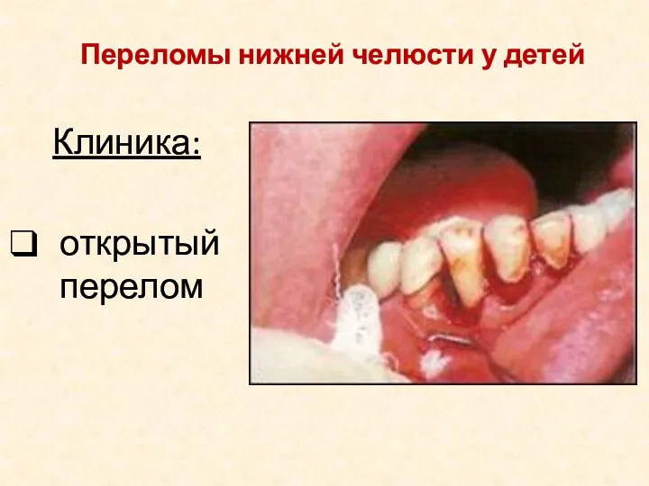 Клиника: открытый перелом Переломы нижней челюсти у детей