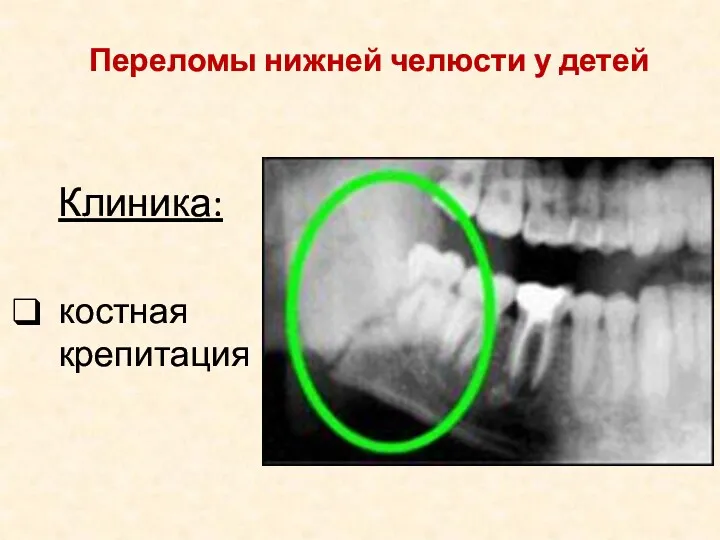 Клиника: костная крепитация Переломы нижней челюсти у детей