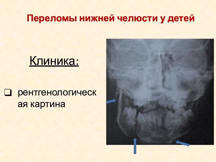 Клиника: рентгенологическая картина Переломы нижней челюсти у детей