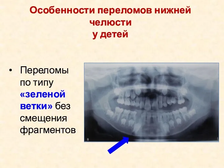 Переломы по типу «зеленой ветки» без смещения фрагментов Особенности переломов нижней челюсти у детей