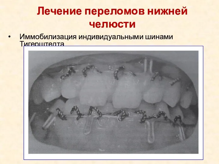 Иммобилизация индивидуальными шинами Тигерштедта Лечение переломов нижней челюсти