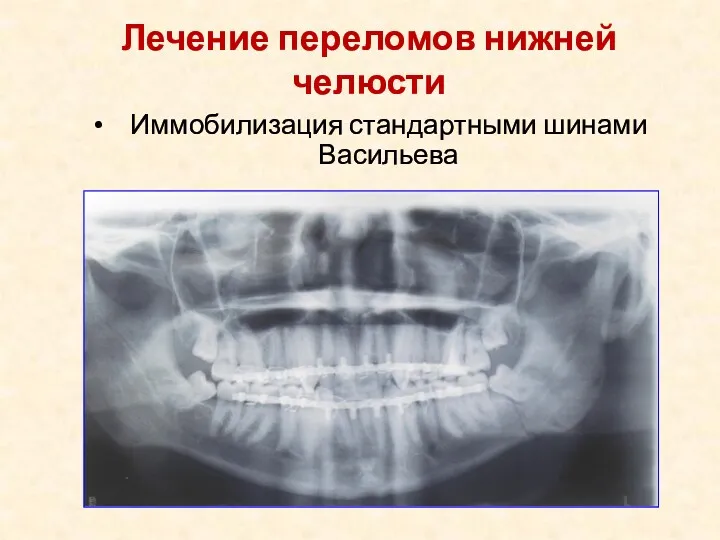 Иммобилизация стандартными шинами Васильева Лечение переломов нижней челюсти