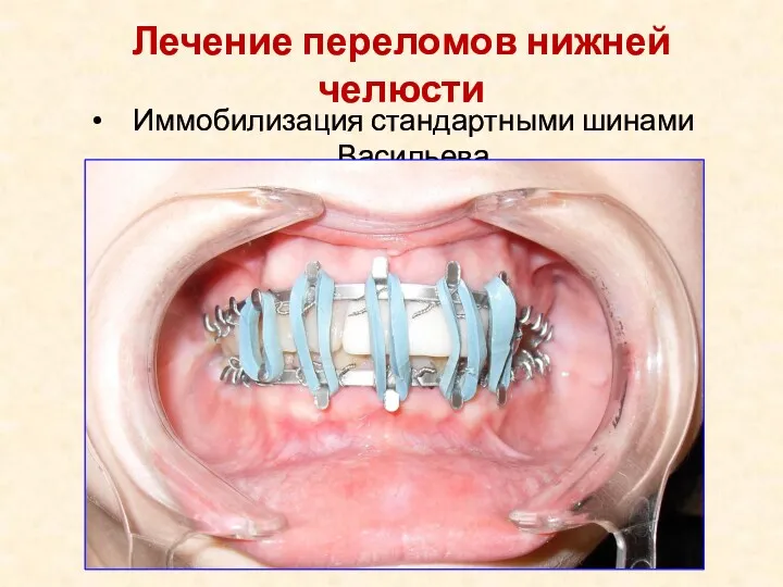 Иммобилизация стандартными шинами Васильева Лечение переломов нижней челюсти